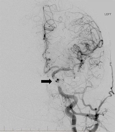 Final Frontal View Left Common Carotid Artery Angiogram Shows