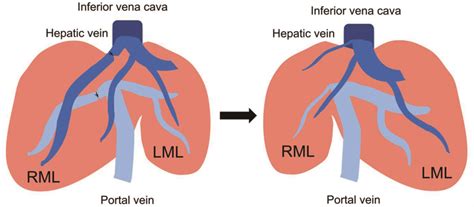 Hepatic Vein Vs Portal Vein