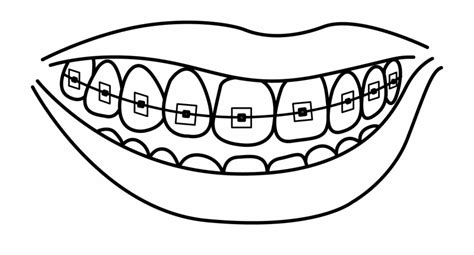 Amazing How To Draw Braces Check It Out Now Howdrawart1