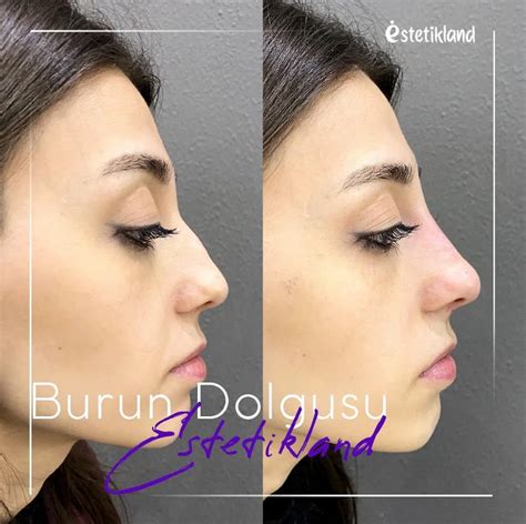 Nose Filler Non Surgical Nose Job Estetikland