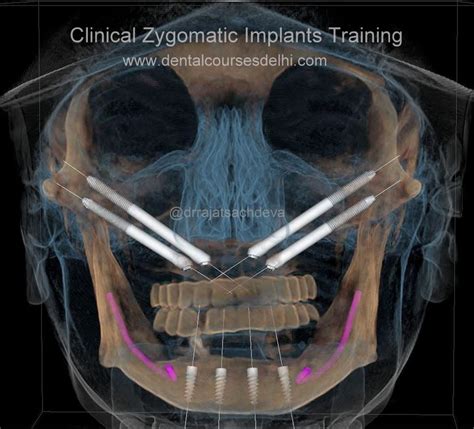 Clinical Zygomatic Pterygoid Implant Course In India