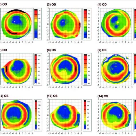 Epithelial Thickness Maps Of Randomly Selected Eyes Each Plotted