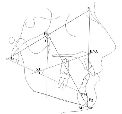 Angular Measurements Used To Determine The Facial Types The Following Download Scientific