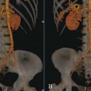 D Reconstruction Of Ct Angiography Of The Aorta Demonstrating Enlarged