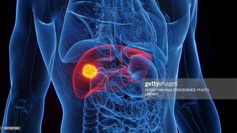 Liver Cancer Illustration High Res Vector Graphic Getty Images