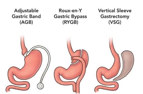 Kinds Of Weight Loss Surgeries Blog Dandk