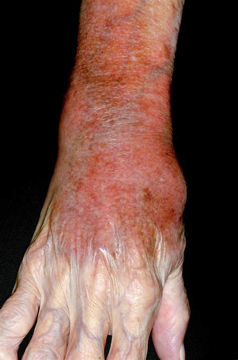 Cellulitis Of The Wrist Photograph By Dr P Marazziscience Photo Library