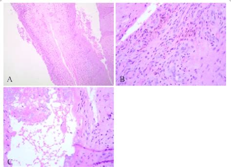 A Cyst Wall With Synovial Lining Hande B Synovial Cyst With