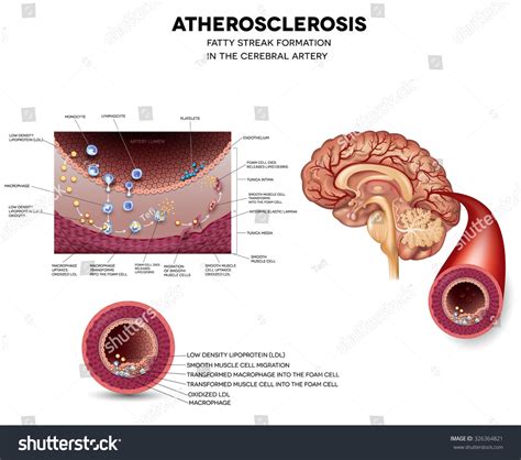 Atherosclerosis Fatty Streak Formation In The Cerebral Artery Stock