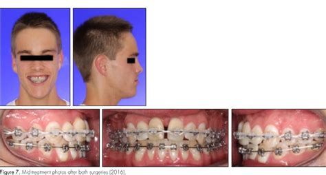 Figure 7 From Single Tooth Osteotomy And Distraction In The Treatment Of An Ankylosed Central