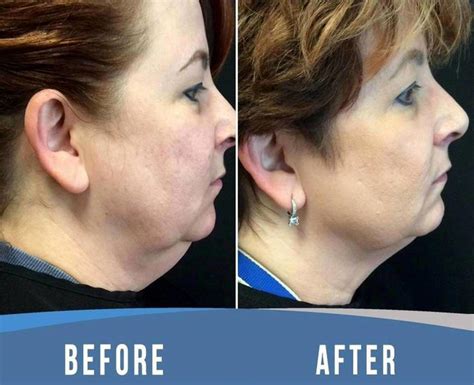 Thermage For Neck Before And After (5) » Facelift: Info, Prices, Photos ...