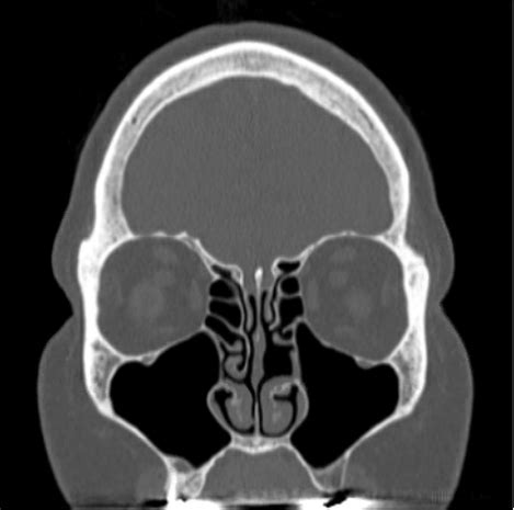 Advanced sinus surgery relieves nasal polyp symptoms – without a long recovery | Discovery | ENT ...