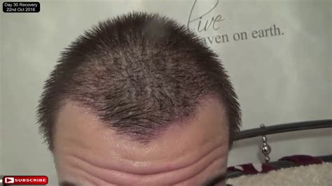 Fue Hair Transplant Day 30 Post Op Recovery Youtube