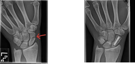 Scaphoid Fracture Treatment Surgery