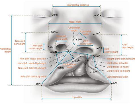 Revisiting The Unrepaired Unilateral Cleft Lip And Nasal Deformity