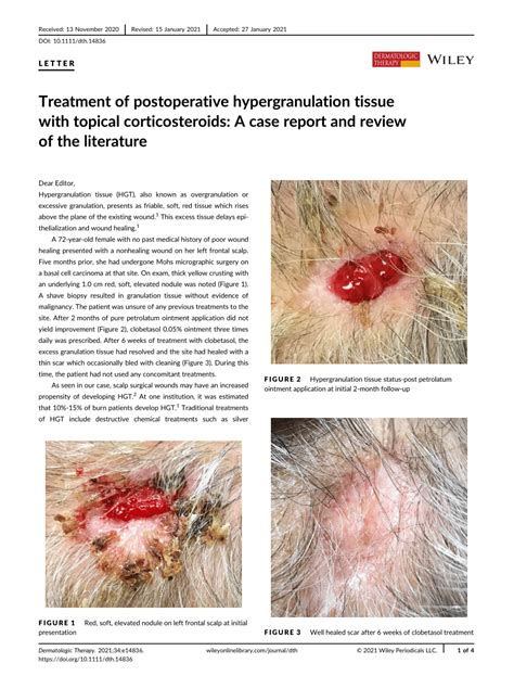 Treatment Of Post‐operative Hypergranulation Tissue With Topical Corticosteroids A Case Report