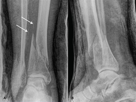 Fixation Of A Distal Diaphyseal Tibia Fracture With Neurovascular