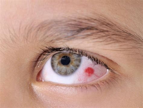 What Is An Eye Hemorrhage With Pictures