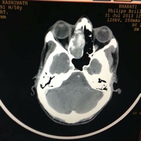 CT scan -A 5x4x4.5 cm sized solid mass in the Rt. Nasal cavity arising ...