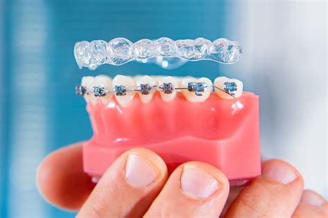 Invisible Braces | Smylor-Dental Treatment Marketplaces