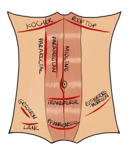 General Surgery Flashcards Quizlet