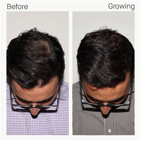 12 People Who Transformed Their Hair With Nutrafol | Nutrafol