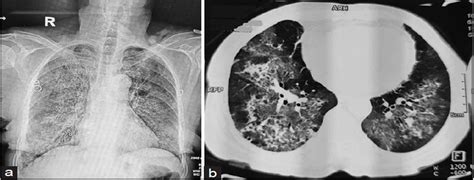 Pulmonary Tuberculosis Presenting As Diffuse Alveolar Hemorr