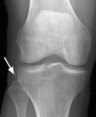 Fibular Collateral Ligament Mri