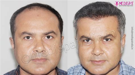 Best Hair Transplant Results Dubai Hair Transplant In Delhi Hair