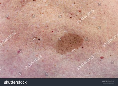 Big Skin Birthmark On Lumbar Part Stock Photo 290047910 Shutterstock