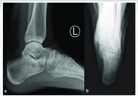 Lateral Radiograph A And Harris View Radiograph B Of Calcaneus