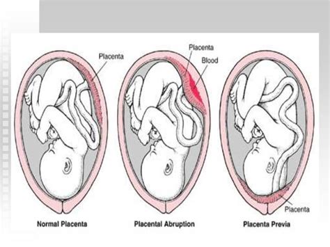 Abruptio Placenta