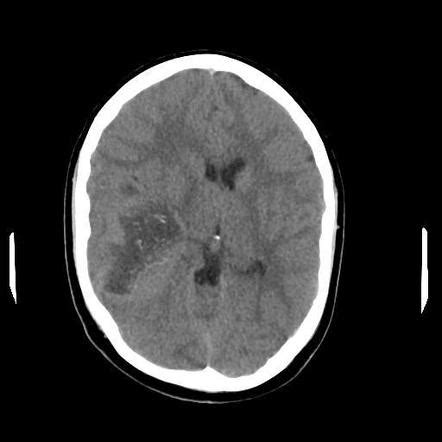 Anaplastic oligodendroglioma NOS | Radiology Reference Article | Radiopaedia.org