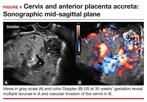 Placenta Positions On Ultrasound