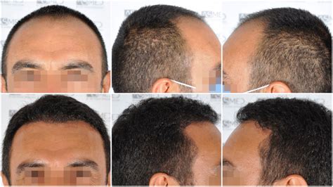 Grafts Fue Norwood Asmed Hair Transplant Results