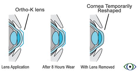 Corneal Refractive Therapy Crt In Chickasha In Chickasha Ortho K