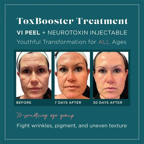Botox in Gig Harbor – Smooth Wrinkles & Refresh