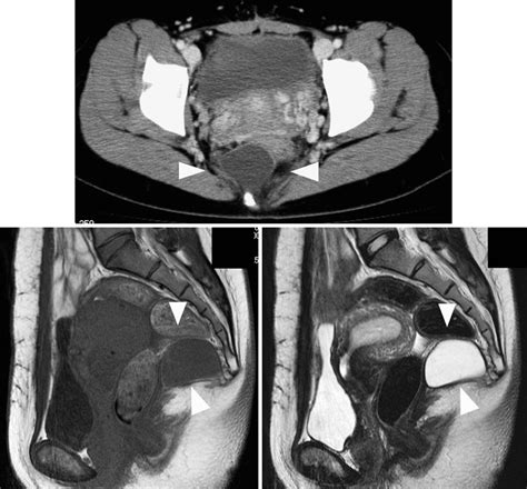 A Pelvic Ct Shows A Cystic Mass In The Presacral Region Which