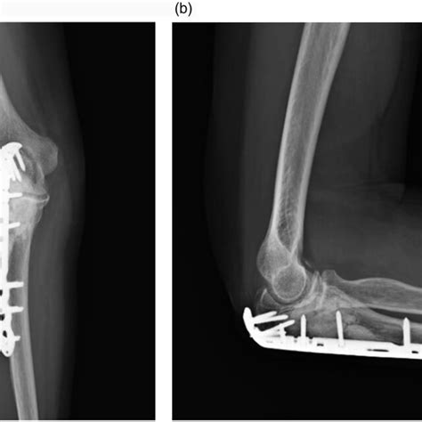 A Anteroposterior Radiography View Of The Right Elbow B Lateral