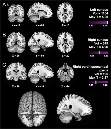 Main Effect Of Carrying Apoe ε4 On Brain Structure In Chinese Results