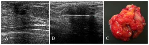 Pilomatrixoma Of The Breast A Rare Lesion Simulating Breast Cancer A