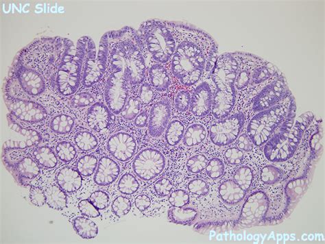 Adenomatous Polyp Histology