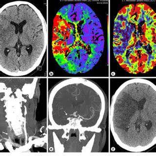 A Axial Non Contrast CT Section Of The Head Shows Established Infarct