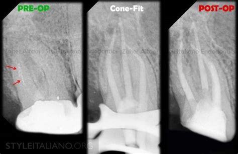 Management Of Broken Files A Clinical Approach Style Italiano Endodontics