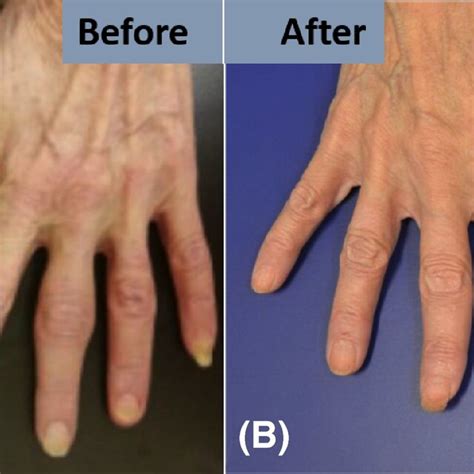 Images Of Clinical Manifestations Of Bazex Syndrome In Patient Before