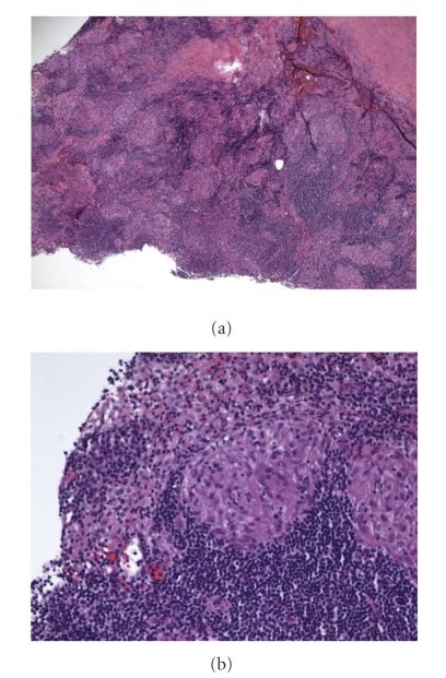 A Lymph Node Biopsy Low Power B Lymph Node Biopsy High Power Download Scientific Diagram