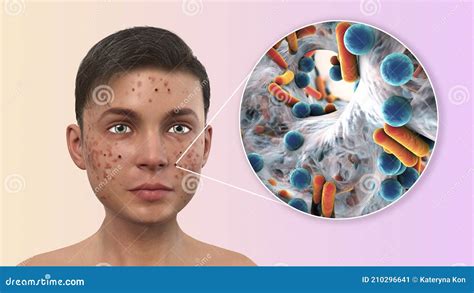 Brufoli Acne E Vista Di Chiusura Dei Batteri Gli Agenti Causali Delle