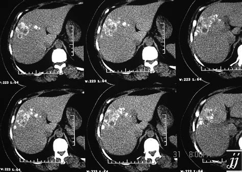 Radioogle Abdomen Calcified Lesion Of The Liver Dead Hydatid Cyst 1