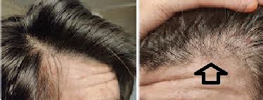 Maturing hairline (photos) – WRassman,M.D. BaldingBlog