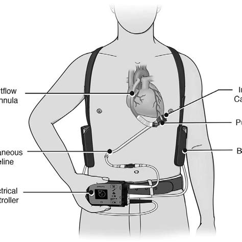 Left Ventricular Assist Devices Currently Available In The United